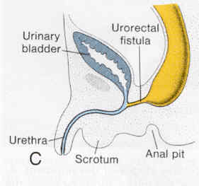 Pardon c'est en anglais ! En jaune : le gros intestin et la fistule entre l'intestin et la vessie, en bleu : la vessie puis l'urètre. Anal pit =emplacement normalement de l'orifice anal