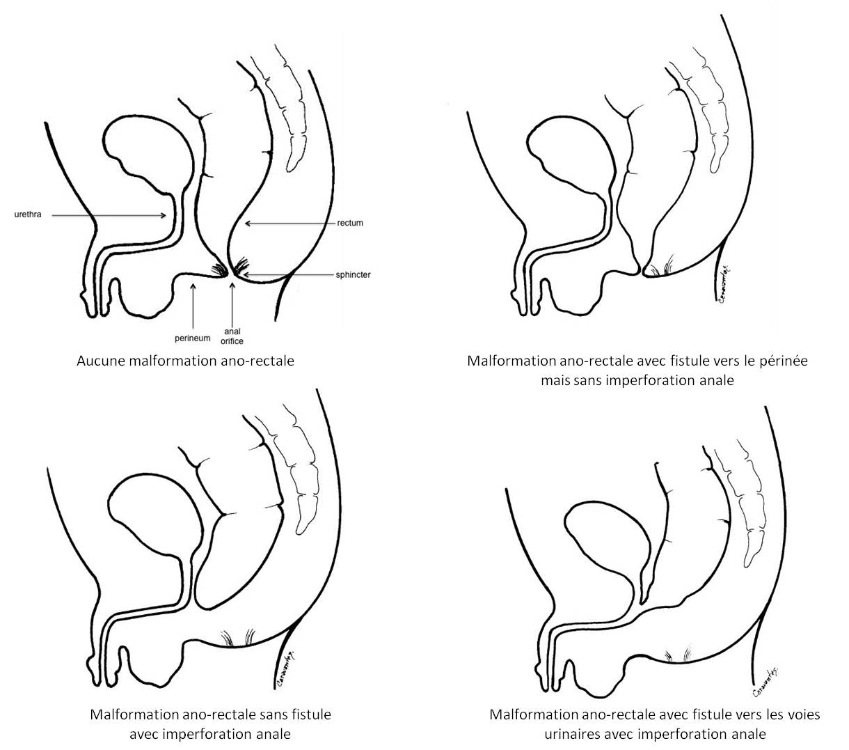 Illustrations des formes de malformations ano-rectales dont l'imperforation anale, chez le garçon 
