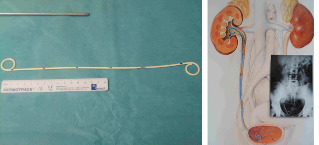 Dispositif mis en place (sonde double J) dans le cas d'une pyélonéphrite obstructive