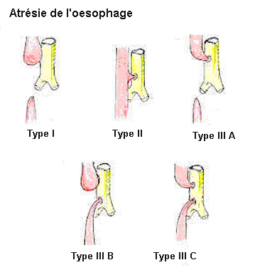 Schéma détaillé des types d'atrésie de l’œsophage