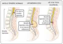 Erythème fessier, les limites des pommades - VACTERL au quotidien