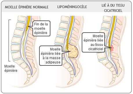 moelle attachée basse vacterl