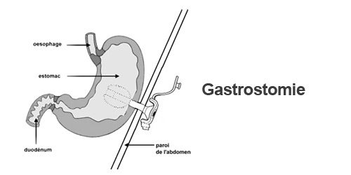 C'est le ballon qui tient la gastrostomie et assure l'étanchéité